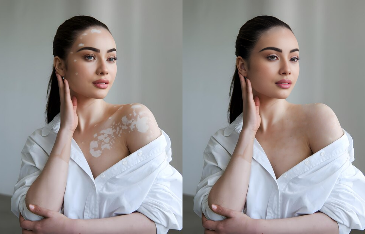 Young Woman with Vitiligo